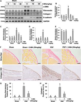 Blockade of Autophagy Prevents the Development and Progression of Peritoneal Fibrosis